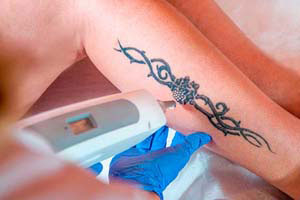 tattooentfernung-zuerich-small.jpg